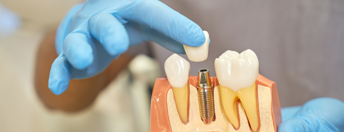 Dental Implants